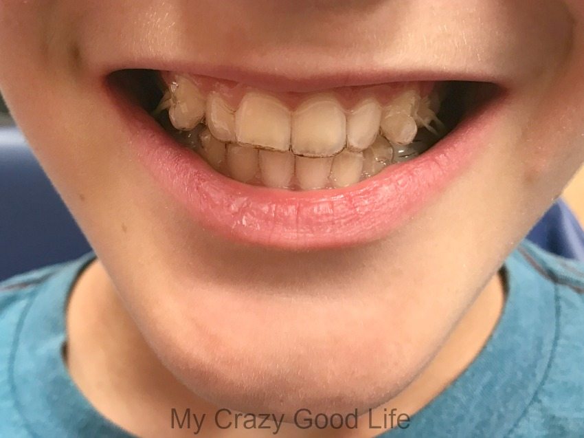 Invisalign Teen Braces 33