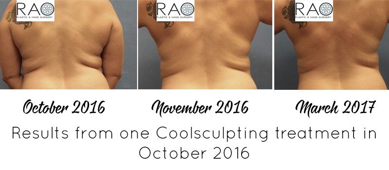 Thinking about trying CoolSculpting to target fat loss and tone up? I reviewed the process and am sharing my story and CoolSculpting results today! 