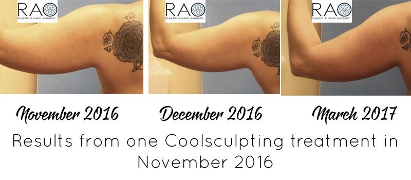 Thinking about trying CoolSculpting to target fat loss and tone up? I reviewed the process and am sharing my story and CoolSculpting results today! 