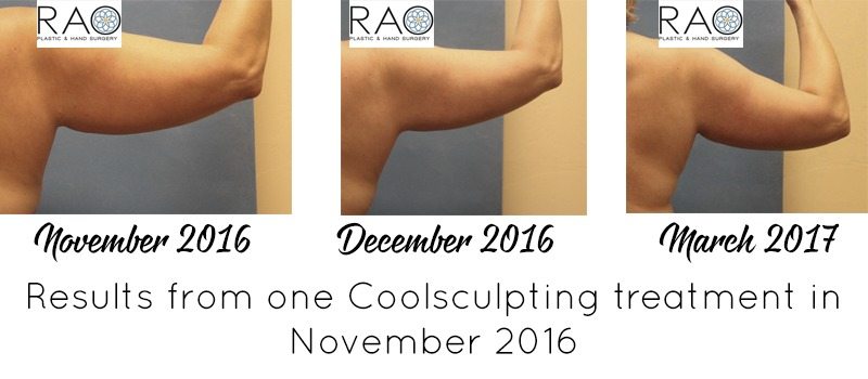 Thinking about trying CoolSculpting to target fat loss and tone up? I reviewed the process and am sharing my story and CoolSculpting results today! 