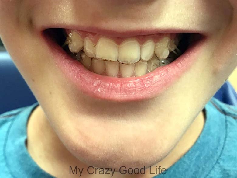 an image of my child's teeth when starting the Invisalign process